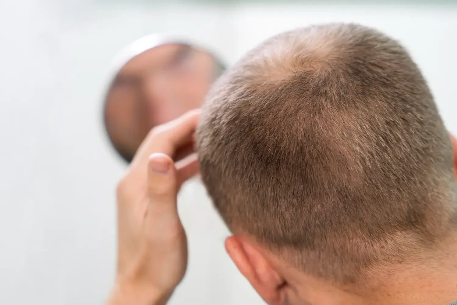 Hair Loss in Men: Causes, Treatments, and What Really Works